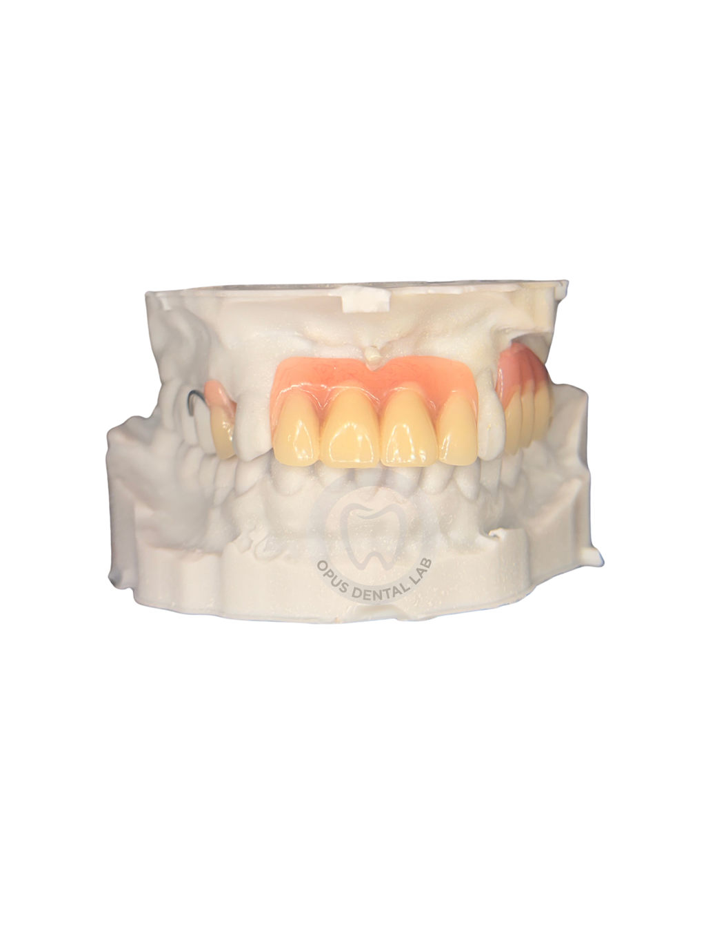 Acrylic Partial Denture